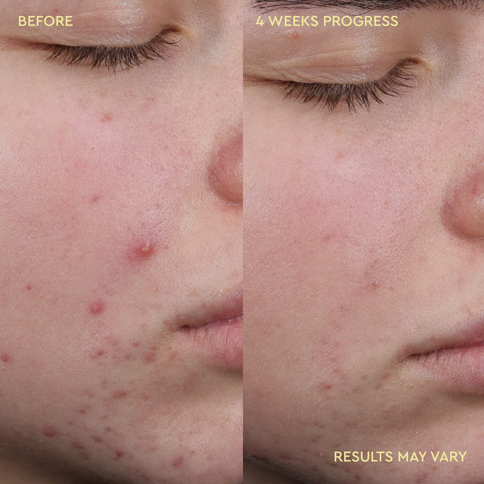 Close-up before-and-after comparison of a person's cheek showing acne improvement over 4 weeks, with text reading 'BEFORE', '4 WEEKS PROGRESS', and 'RESULTS MAY VARY'.