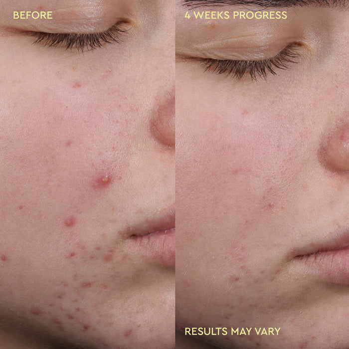 A close-up before-and-after comparison of a person's face showing acne improvement over 4 weeks. The left side is labeled 'BEFORE' and shows visible red blemishes and pustules on the cheek.
