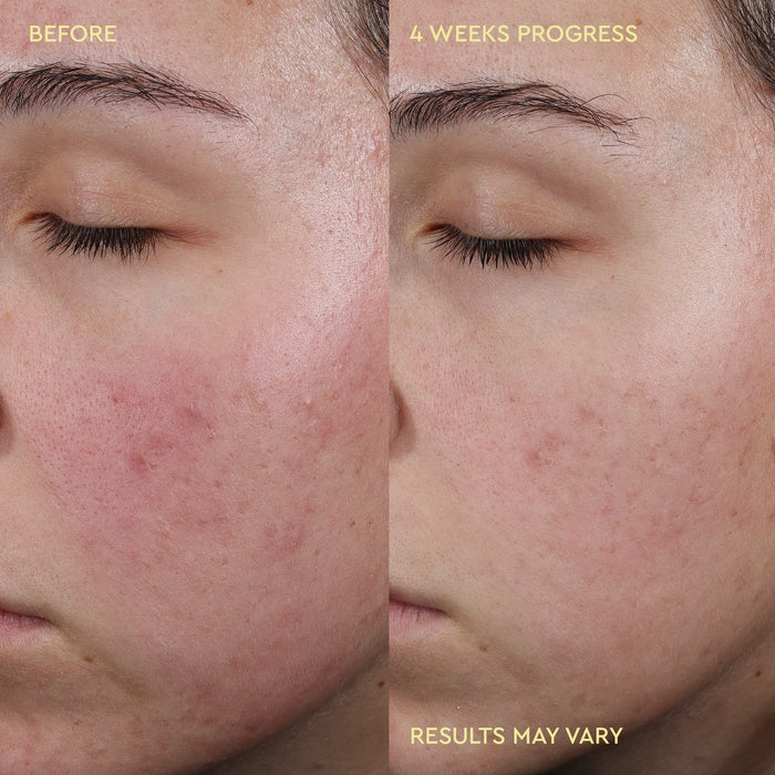 A split-screen close-up of a woman's cheek and eye area labeled 'BEFORE' on the left and '4 WEEKS PROGRESS' on the right, with 'RESULTS MAY VARY' at the bottom. The image shows skin improvement over time rather than a standalone physical product shot.