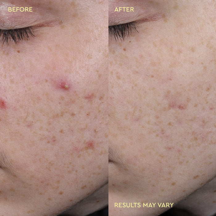 Close-up before-and-after comparison of a person's cheek showing improvement in skin texture and blemishes, with text reading BEFORE, AFTER, and RESULTS MAY VARY.