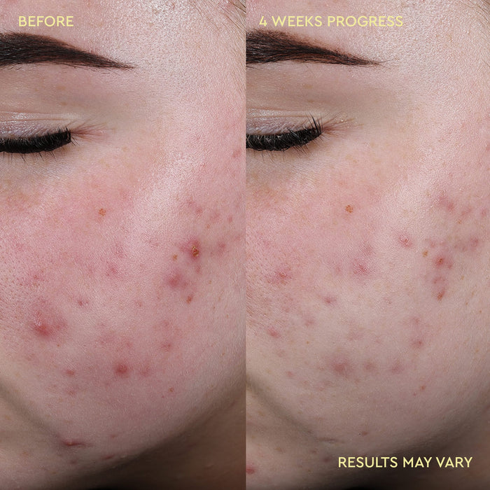 Close-up before-and-after comparison of a person's cheek showing acne improvement over 4 weeks, with text reading 'BEFORE', '4 WEEKS PROGRESS', and 'RESULTS MAY VARY'.